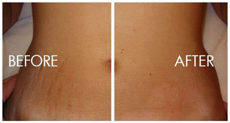 Helps with reduction of stretch marks
